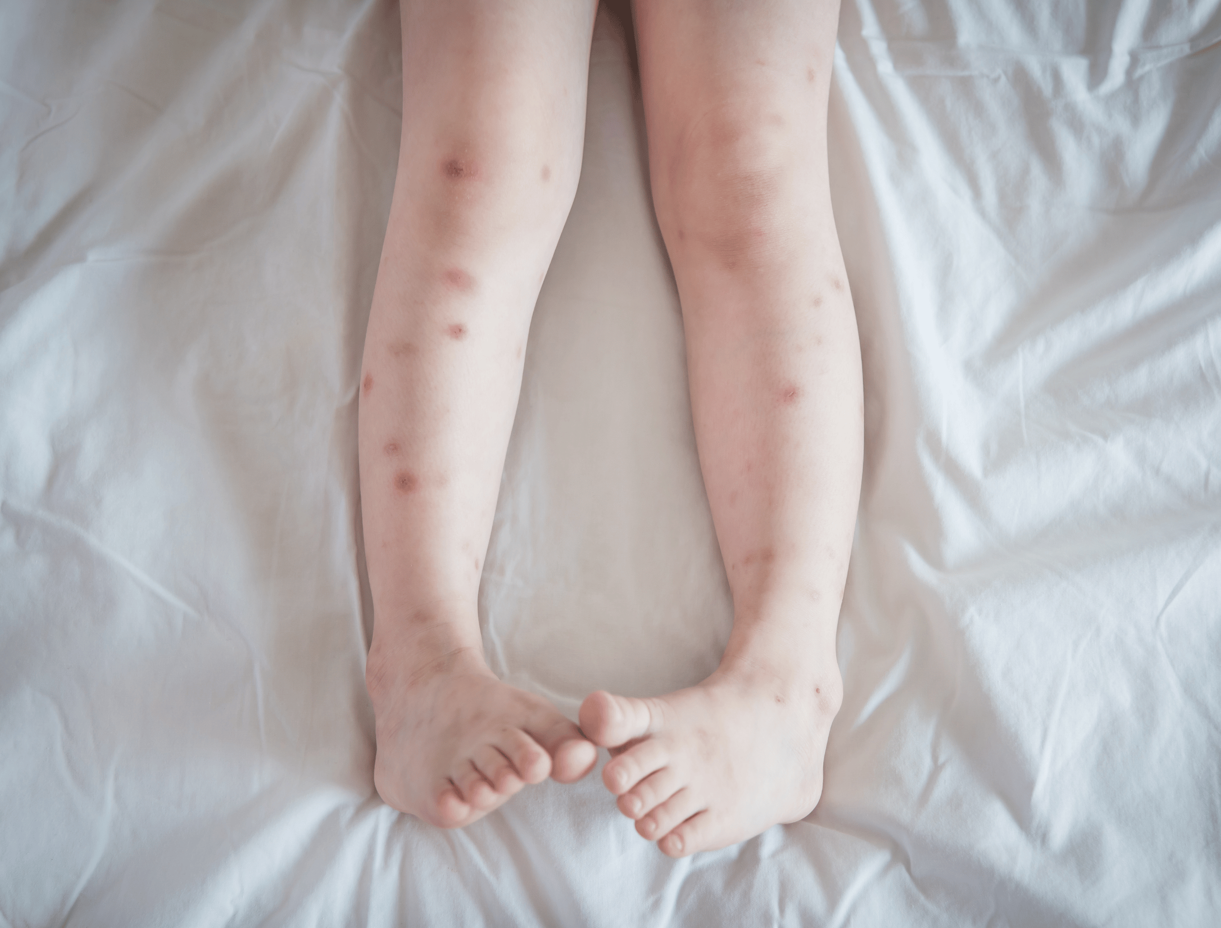 Bed bug bites on a leg